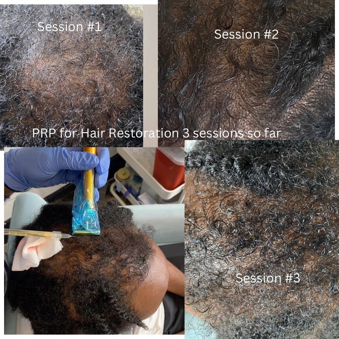 Hair restoration (PRP)
