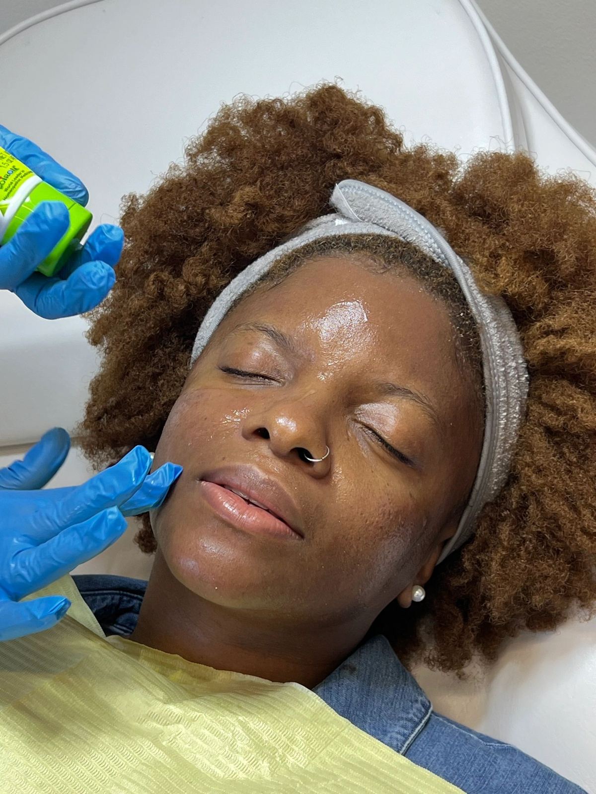 Microneedling with PRP